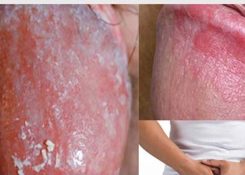 Nấm dương vật phát bệnh bao lâu? có nguy hiểm không?