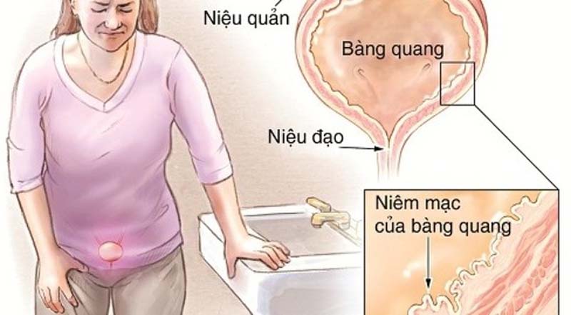 Viêm đường tiểu là gì?