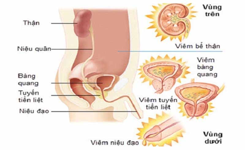 Cách phân biệt 2 bệnh viêm niệu đạo và viêm đường tiết niệu