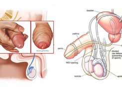 Phân biệt viêm niệu đạo và viêm đường tiết niệu