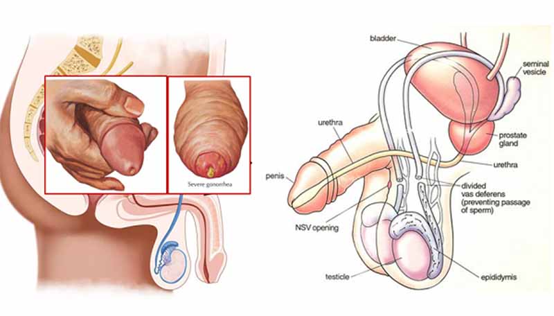 Viêm niệu đạo và viêm đường tiết niệu