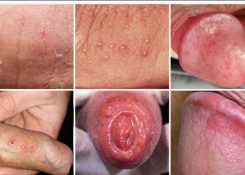 Đầu chim nổi mẩn đỏ ngứa là dấu hiệu bệnh gì?