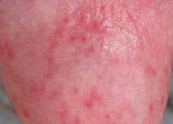 Đầu dương vật nổi mẩn đỏ ngứa là dấu hiệu bệnh gì?