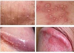 Nguyên nhân dương vật nổi mụn và cách điều trị