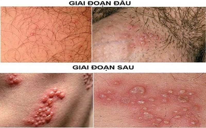 Bệnh mụn rộp sinh dục (Herpes sinh dục)