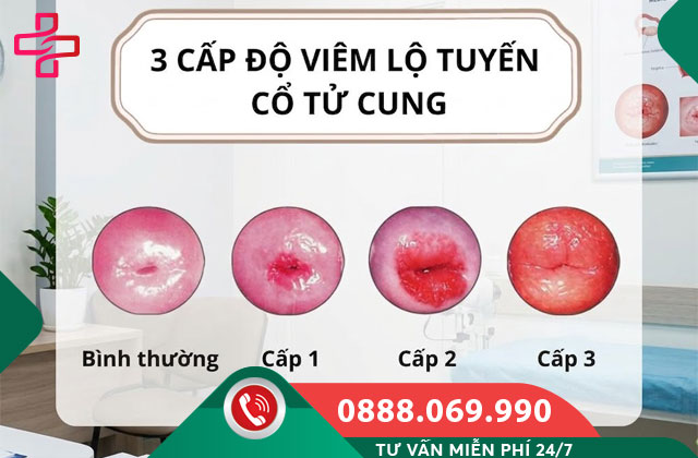 Các mức độ viêm lộ tuyến