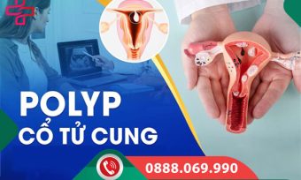Polyp cổ tử cung là gì? Nguyên nhân, triệu chứng và cách điều trị từ A-Z