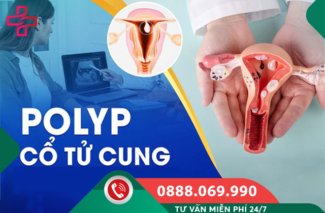 Polyp cổ tử cung là gì?