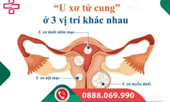 U xơ tử cung là gì? Nguyên nhân, triệu chứng và cách điều trị từ A-Z