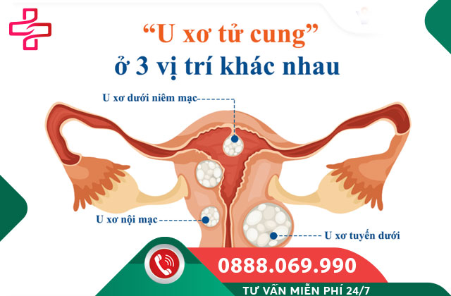 U xơ tử cung là gì