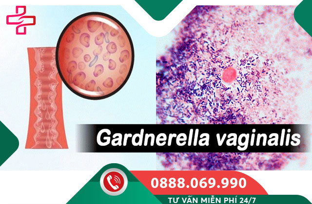 Viêm âm đạo do trực khuẩn Gram