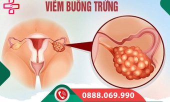 Viêm buồng trứng: Nguyên nhân, triệu chứng, cách điều trị