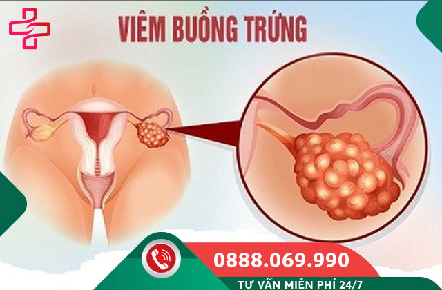 Viêm buồng trứng là gì?