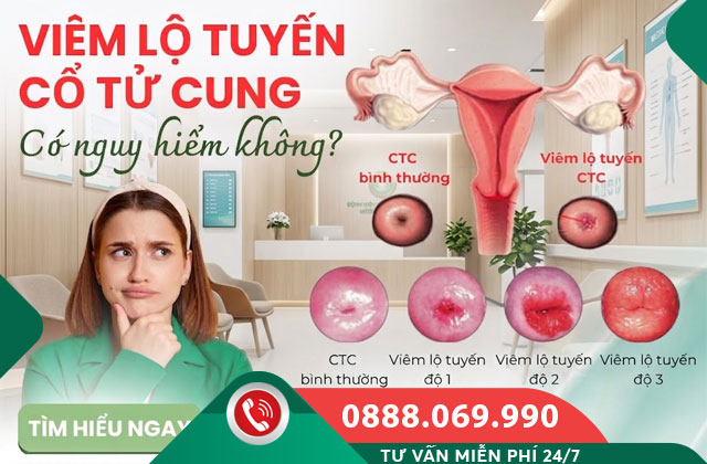 Viêm lộ tuyến cổ tử cung có nguy hiểm không?