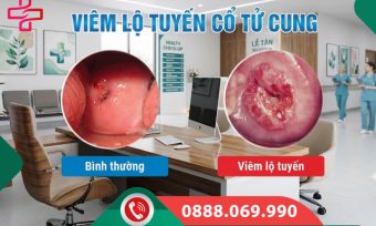Viêm lộ tuyến cổ tử cung: Nguyên nhân, dấu hiệu và cách chữa