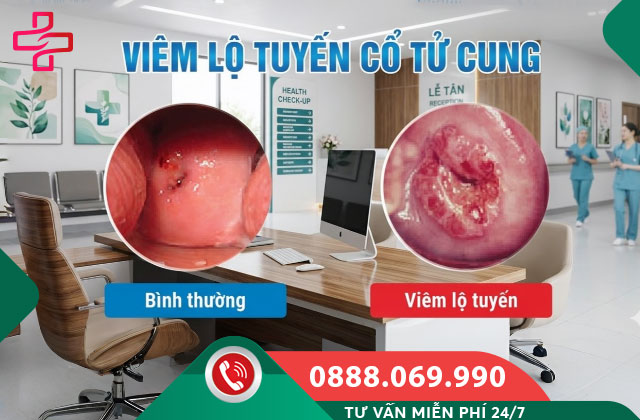 Viêm lộ tuyến cổ tử cung