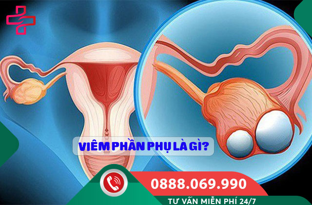Viêm phần phụ là gì