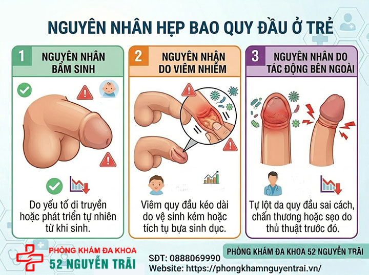 Hẹp bao quy đầu ở trẻ: Dấu hiệu nhận biết và cách xử lý 10 Ảnh minh hoạ Nguyên nhân hẹp bao quy đầu ở trẻ