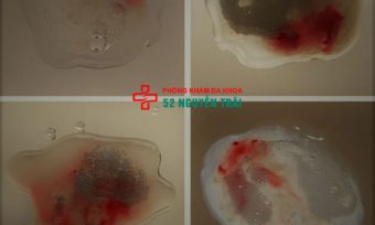 Xuất tinh ra máu, tinh trùng lẫn máu là bệnh gì? Khám nhanh & bảo mật tại hà nội