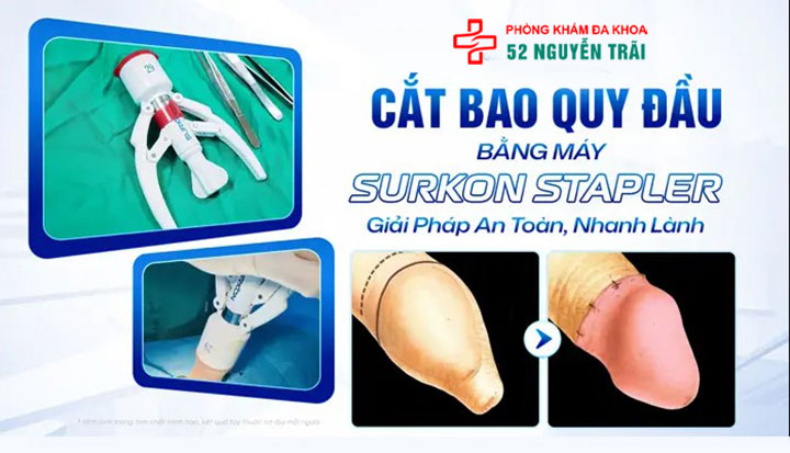 Giới thiệu Phòng khám Đa khoa 52 Nguyễn Trãi: Địa chỉ khám uy tín tại Hà Nội 6 Công nghệ cắt bao quy đầu Stapler Surkon