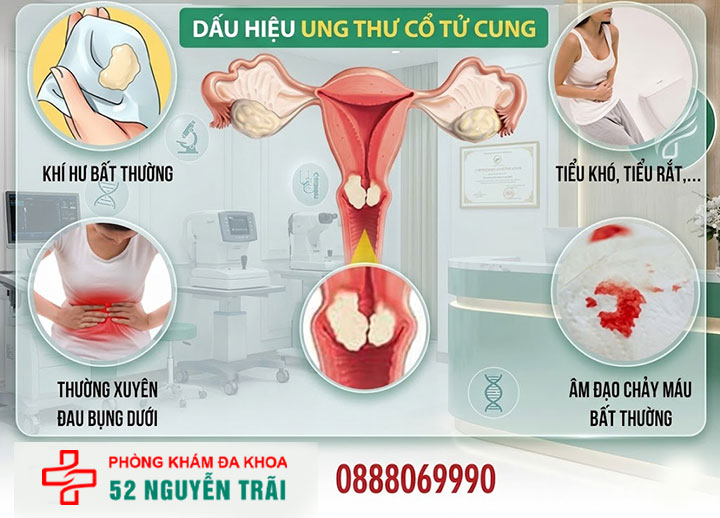 dấu hiệu Ung thư cổ tử cung