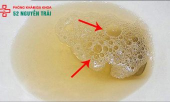 Đi tiểu buốt, nước tiểu có bọt là bệnh gì? Khám nhanh & bảo mật tại hà nội