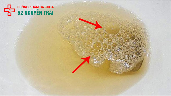 Đi tiểu buốt, nước tiểu có bọt là bệnh gì? Khám nhanh & bảo mật tại hà nội 1 Đi tiểu buốt, nước tiểu có bọt