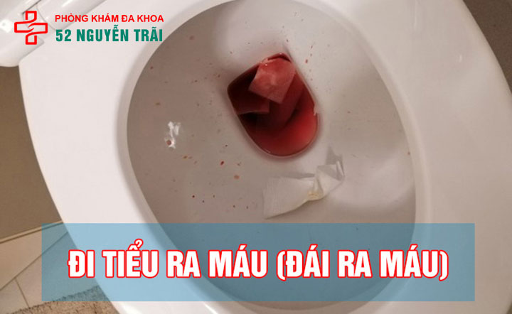 Hiện tượng tiểu ra máu ở nữ là bệnh gì? Khám nhanh & bảo mật tại hà nội 1 Hiện tượng tiểu ra máu ở nữ
