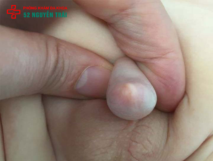 Hẹp bao quy đầu ở trẻ: Dấu hiệu nhận biết và cách xử lý 6 Hình ảnh hẹp bao quy đầu ở trẻ