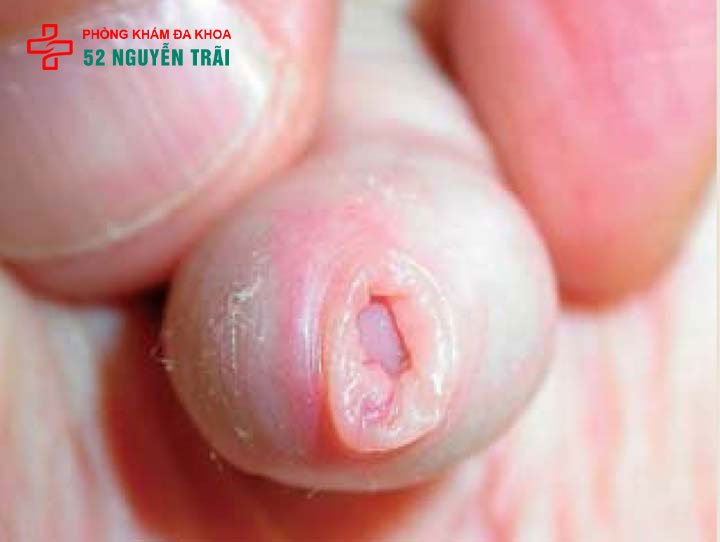 Hẹp bao quy đầu ở trẻ: Dấu hiệu nhận biết và cách xử lý 7 Hình ảnh hẹp bao quy đầu ở trẻ