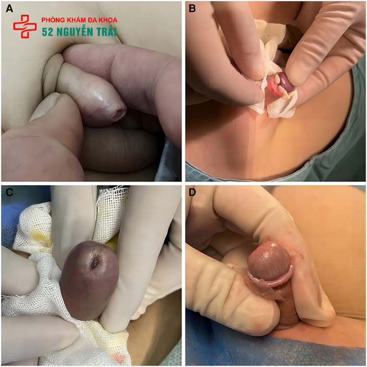 Hẹp bao quy đầu ở trẻ: Dấu hiệu nhận biết và cách xử lý 4 Hình ảnh hẹp bao quy đầu ở trẻ