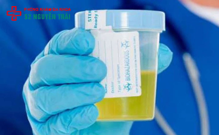 Đi tiểu buốt, nước tiểu có bọt là bệnh gì? Khám nhanh & bảo mật tại hà nội 3 Nguyên nhân gây tiểu buốt có bọt