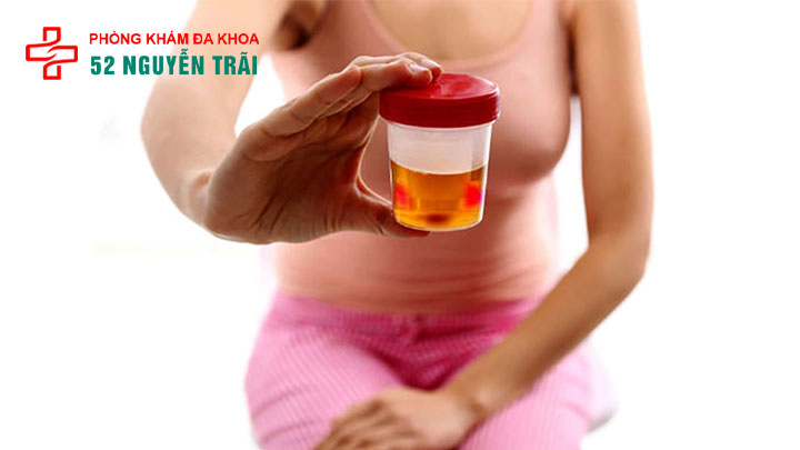 Hiện tượng tiểu ra máu ở nữ là bệnh gì? Khám nhanh & bảo mật tại hà nội 3 Nguyên nhân gây tiểu ra máu ở nữ