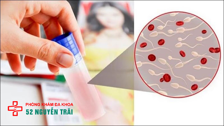 Tinh trùng có máu: nguy cơ bệnh lý nguy hiểm không thể chủ quan! 3 Nguyên nhân gây tinh trùng có máu
