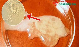 Tinh trùng màu vàng, tinh dịch đục vàng là bệnh gì? Khám bảo mật tại hà nội