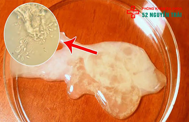 Tinh trùng màu vàng: có nguy hiểm không? Là dấu hiệu của bệnh gì? 3 Tinh trùng màu vàng