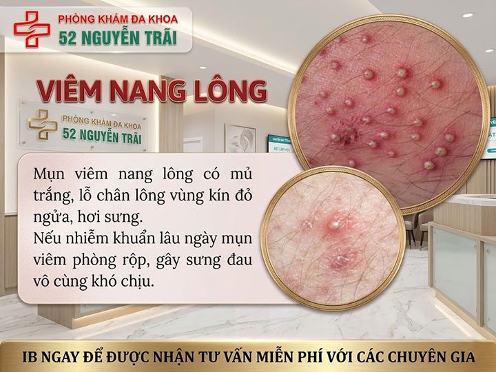 viêm nang lông vùng kín