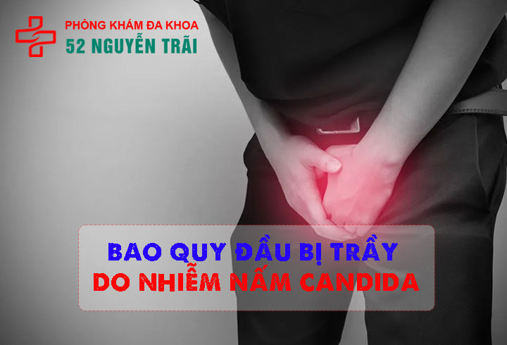 Bao quy đầu bị trầy do nhiễm nấm candida