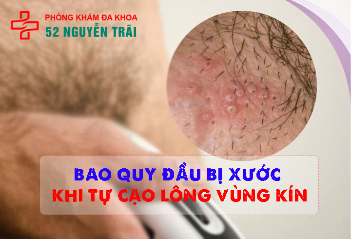 Bao quy đầu bị xước khi tự cạo lông vùng kín