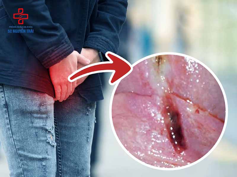 Bao quy đầu bị xước