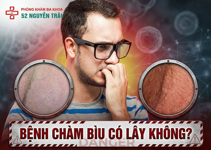 Bệnh chàm bìu có lây không