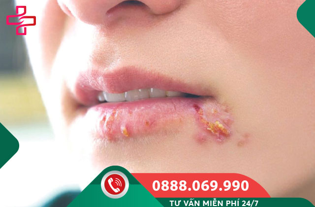Bệnh herpes sinh dục