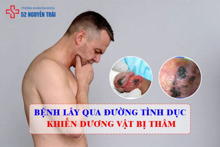 Bệnh lây qua đường tình dục khiến dương vật bị thâm tím