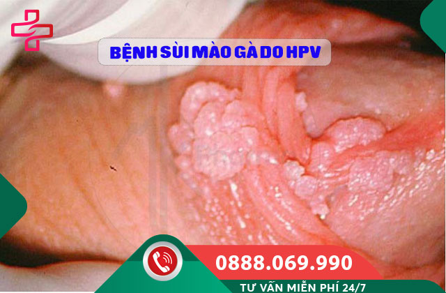 Bệnh sùi mào gà do HPV