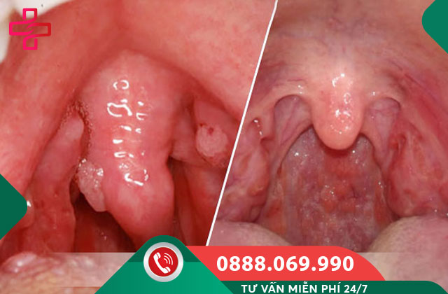 Bệnh sùi mào gà