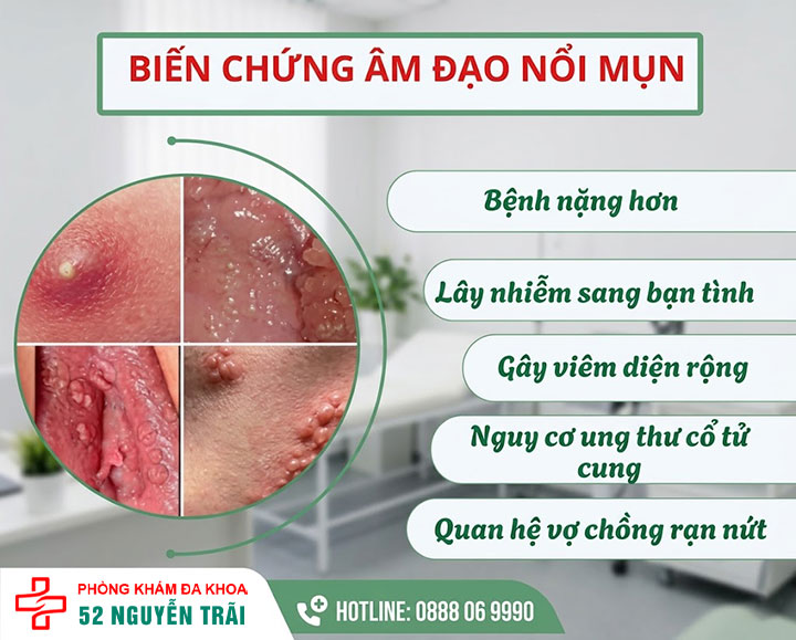 Nổi mụn ở cô bé là dấu hiệu gì? Nguyên nhân và cách chữa 13 biến chứng âm đạo nổi mụn