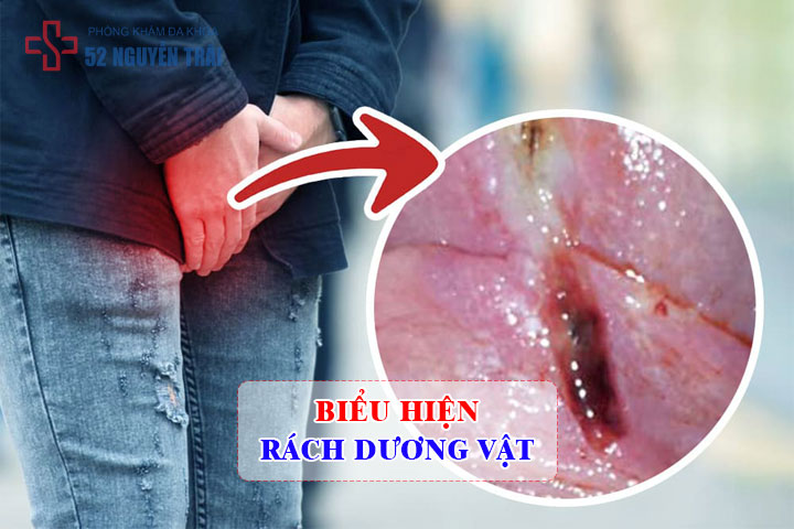 Biểu hiện khi bao quy đầu ở nam giới bị rách