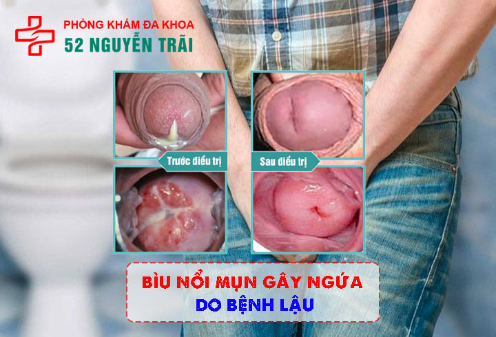 Bìu nổi mụn gây ngứa do Bệnh lậu