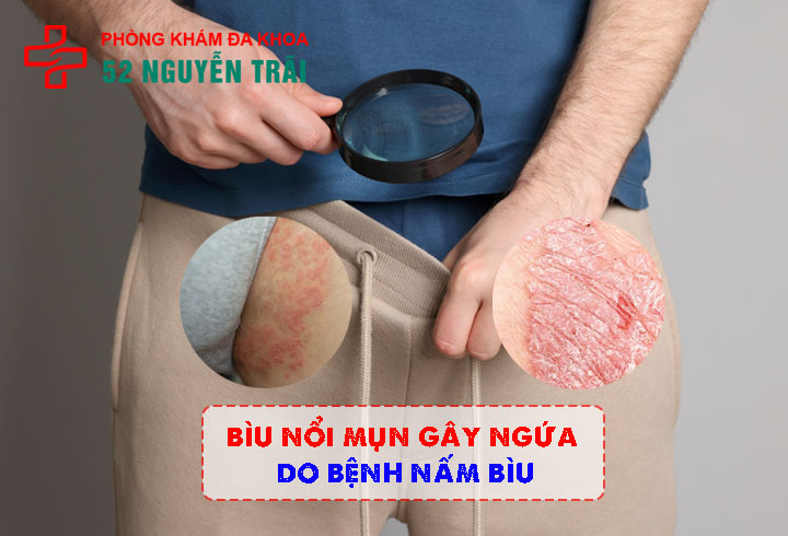 Bìu nổi mụn gây ngứa do bệnh nấm bìu