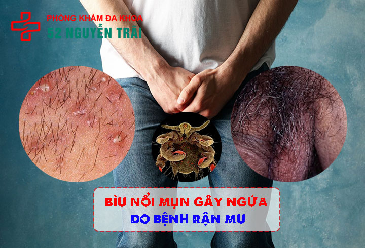 Bìu nổi mụn gây ngứa do Bệnh rận mu